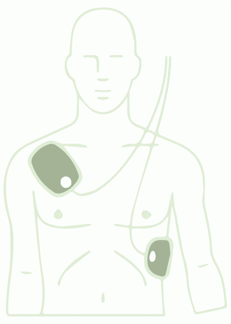 defibrillator_elektroden_anwendung